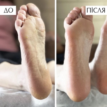 Кератолітик для видалення мозолів та натоптишів PNB Кera Podoliquid 100 мл - Pampik - 3