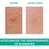 Паста від висипань Uriage Eau Thermale SOS-догляд для жирної та проблемної шкіри 15 мл - Pampik - 6